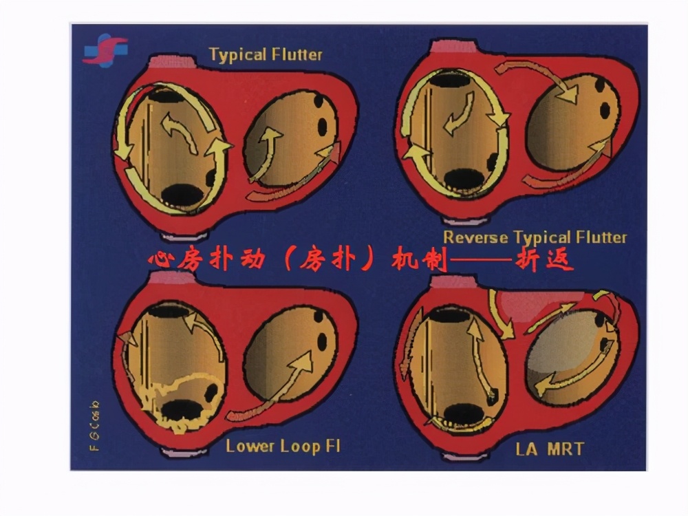 房颤与心律失常怎么解决,心律失常房颤的症状及危害