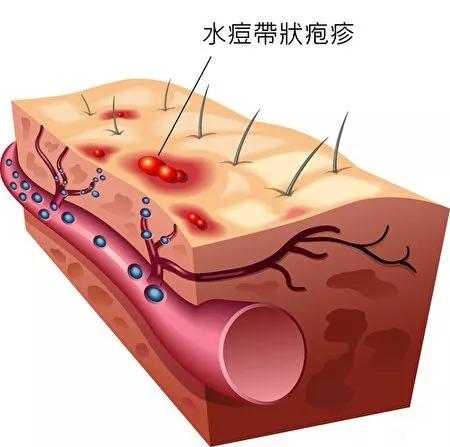 颈椎病疼痛难忍怎么办,颈椎病反反复复的痛该怎么办