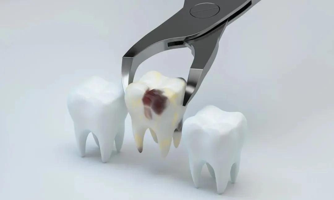 拔牙应该买什么保险,拔牙补牙可以买保险吗