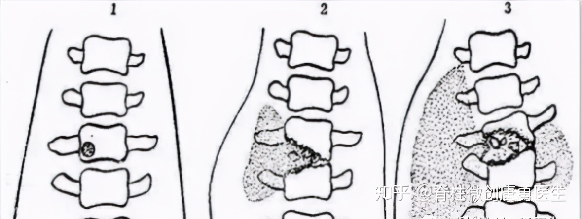 腰痛是不是肾肿瘤,腰痛要警惕腰椎间盘突出