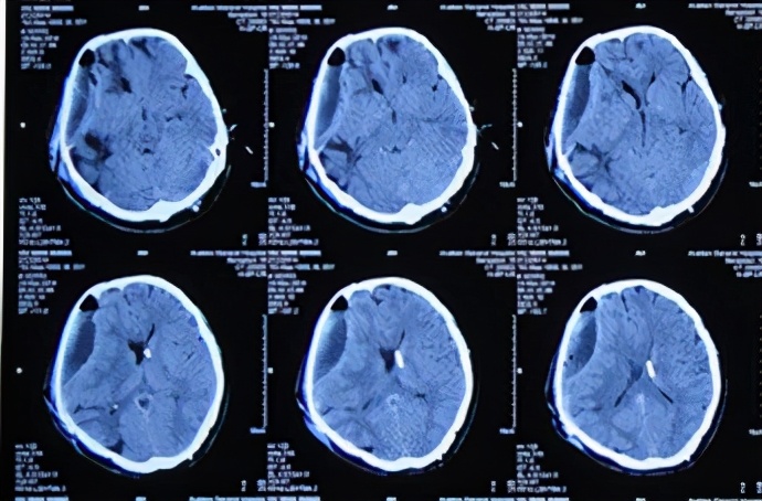 脑外伤开颅手术后脑积水,脑外伤手术后脑脊液鼻漏怎么治疗