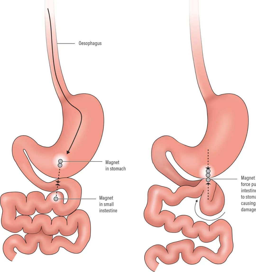 曾有女童误食磁力珠致14处肠穿孔,12岁男孩误食8个磁力珠致肠穿孔