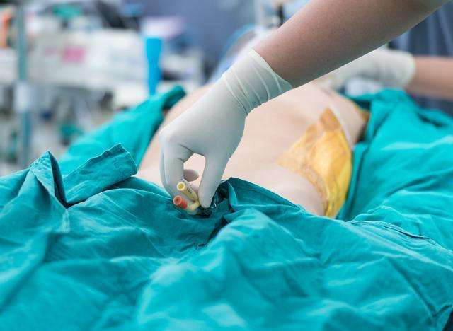 尿管怎么引流,尿管不通畅如何冲洗