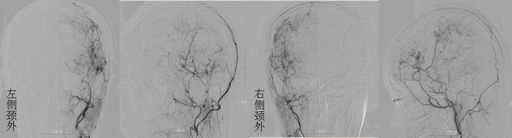 医生给脑血管搭桥,外科医生给年轻女孩做手术
