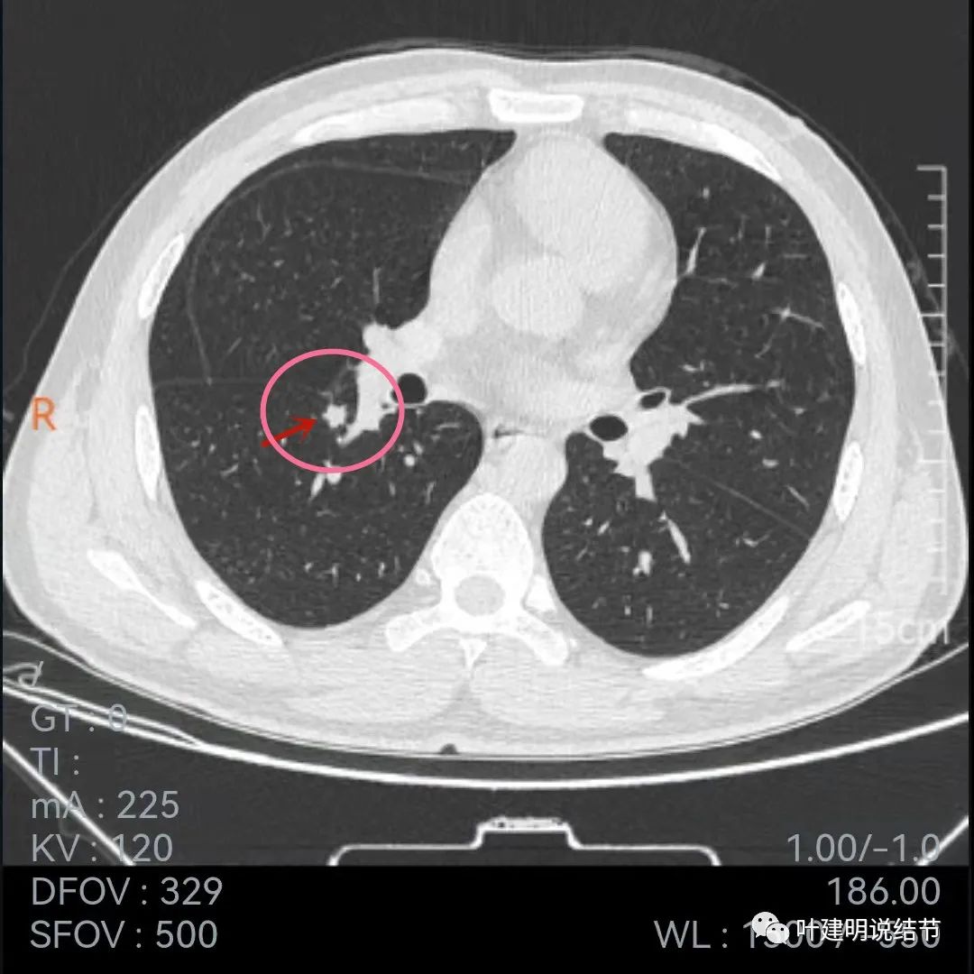 问诊分析：存在了4年的实性结节会不会是肺癌？
