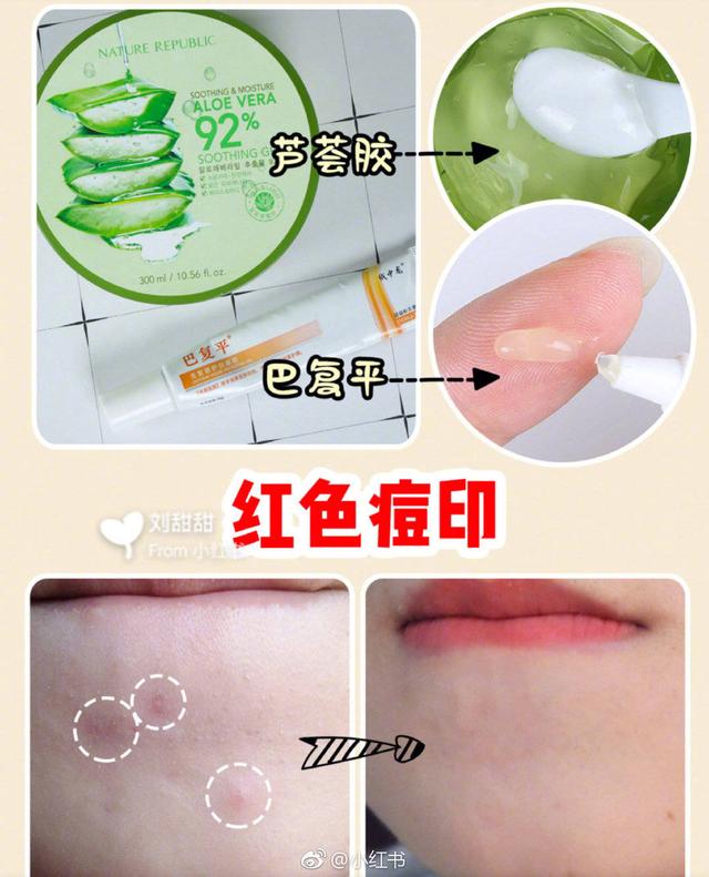 身上的痘痘跟痘印该怎么去除,祛除痘痘和痘印最快方法