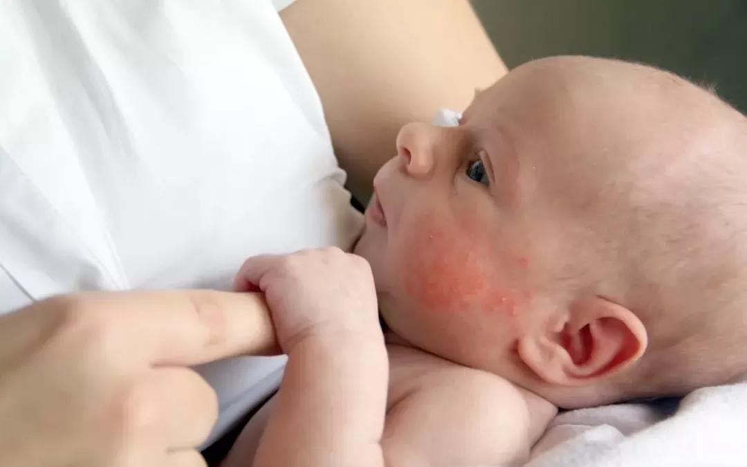 宝宝霜能治疗湿疹吗,宝宝用弱效激素治疗湿疹