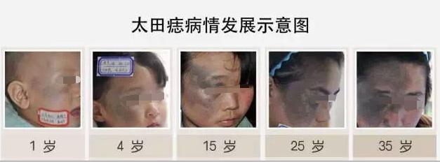 太田痣第一次激光后有效果吗,太田痣激光后掉痂多久能碰水