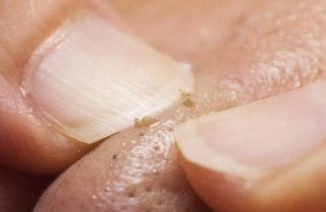 女孩子鼻子黑头怎么去除,鼻子上闭口黑头怎么去掉