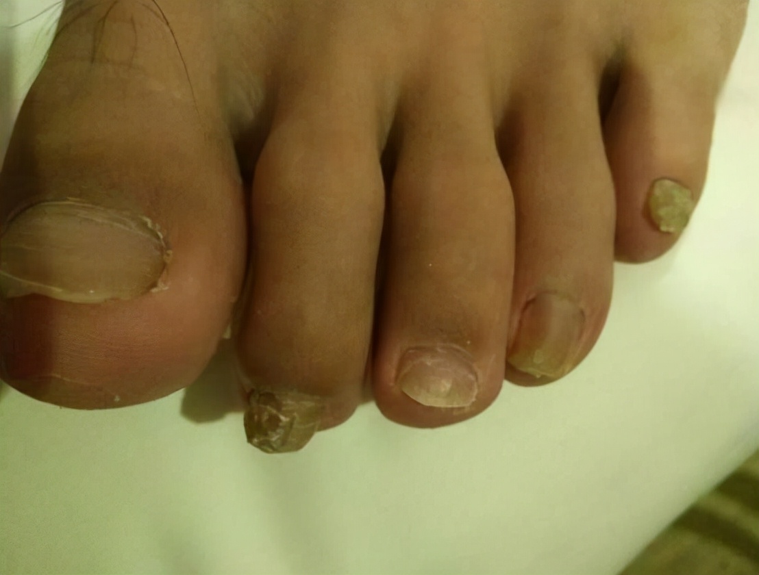 脚指甲变厚变黄空心是灰指甲吗,指甲变厚是灰指甲的前兆