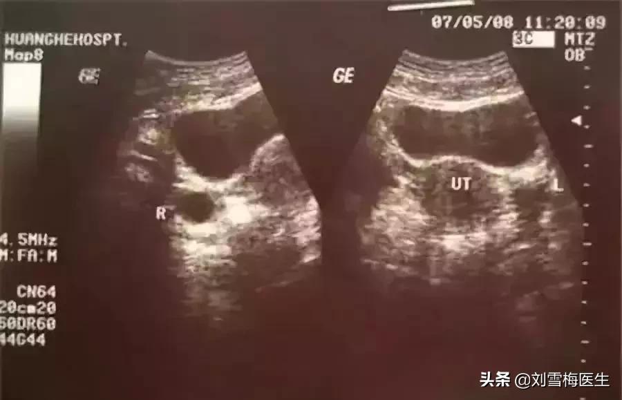 b超监测排卵怀孕成功率有多少,17号排卵几号做b超能查出怀孕