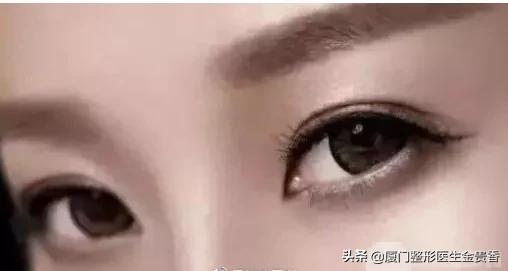 纳米无痕埋线双眼皮需不需要拆线,纳米无痕双眼皮动画操作过程视频