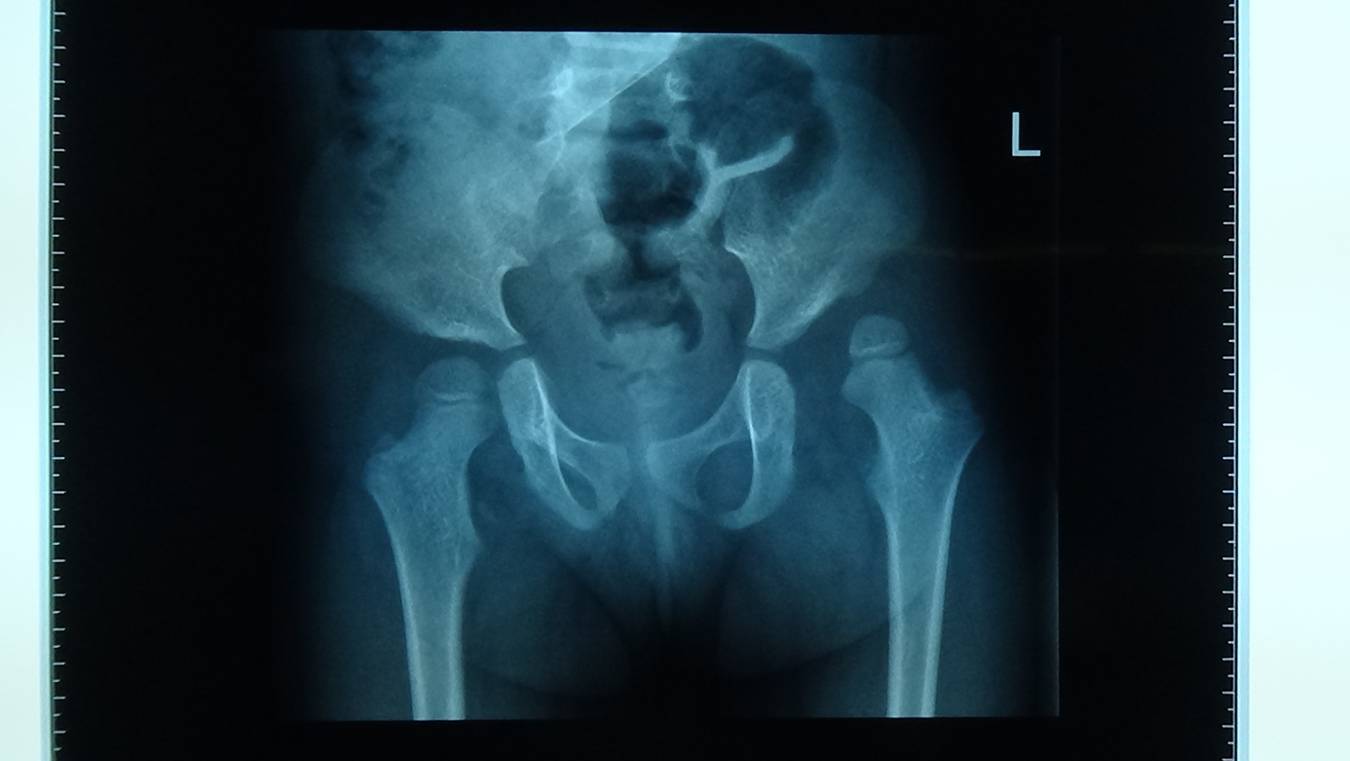 先天性髋脱位治疗方法,先天性髋关节挛缩