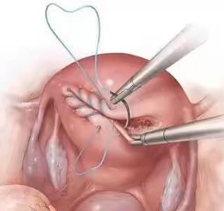 瘢痕子宫再剖腹产危险吗,疤痕子宫就是肚皮上的疤痕吗