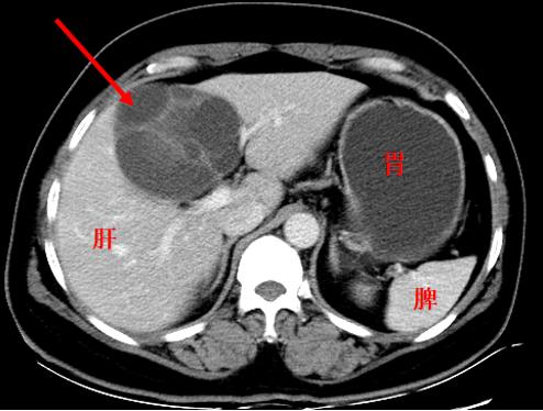 肿块一定是癌症吗,肿块是肿瘤吗