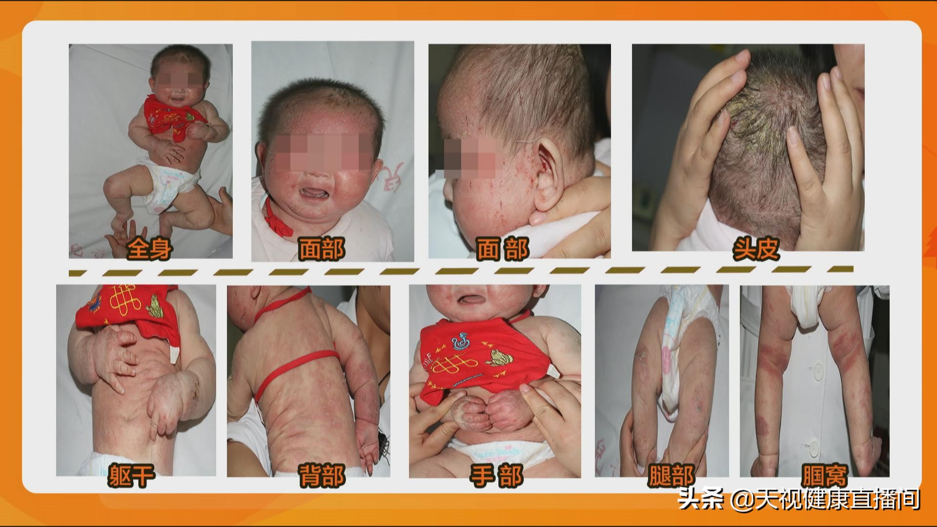 祛除小儿湿疹最好的方法,小儿湿疹最怕的三个土办法