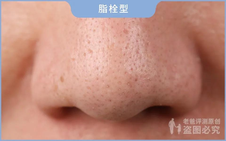 黑头怎么从根部去除,黑头到底怎么去