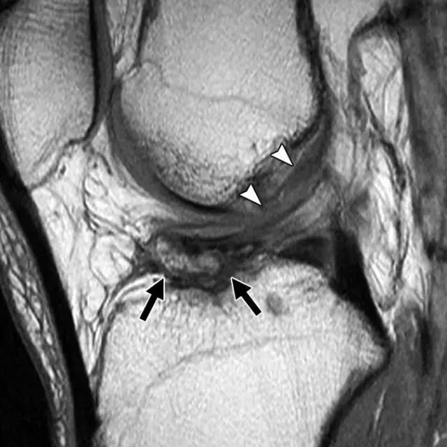 骨折处出现麻痹感,骨折跟精神状态有关