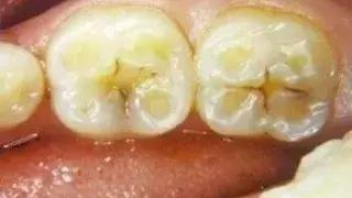 酸倒牙怎么快速恢复,酸倒牙是怎么回事