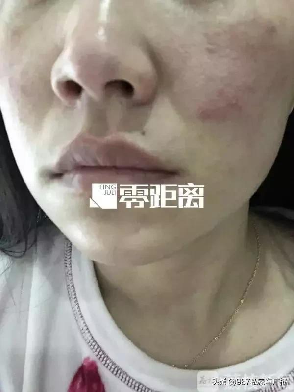 坑!福州徐小姐花1万7做美容,结果脸僵了....