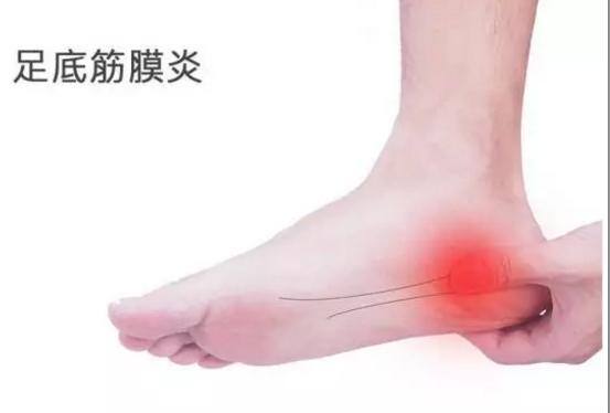 走路脚跟痛当心足底筋膜炎,足底筋膜炎为什么脚跟痛