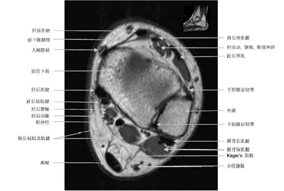 踝关节撞击症问诊,踝关节内侧撞击综合症位置图