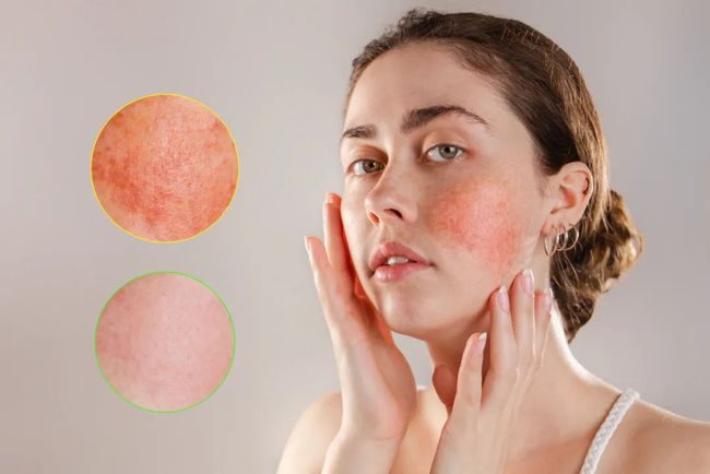 敏感肌脸部过敏最简单的处理方法,脸过敏了红痒怎么迅速脱敏