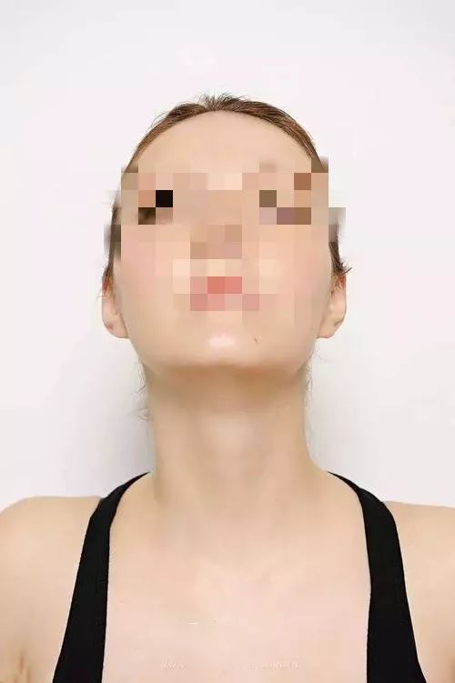 儿童甲状腺弥漫性肿大可早期预防,甲状腺疾病如何通过自检发现