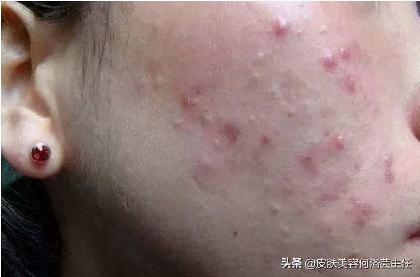 痘痘会家族遗传吗,痘痘会不会遗传下一代