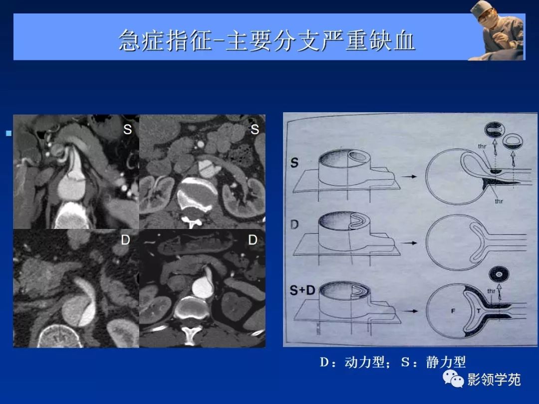 主动脉夹层壁间血肿如何鉴别,主动脉夹层血肿溃疡