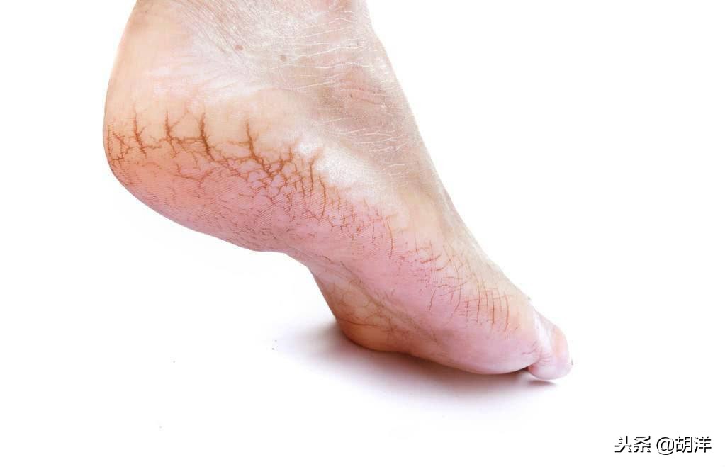 脚后跟开裂是怎么回事？医生建议：4招赶走杀手，哪怕做1个都行