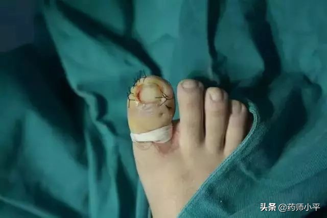 指甲长肉里疼怎么办,指甲往肉里长怎么办