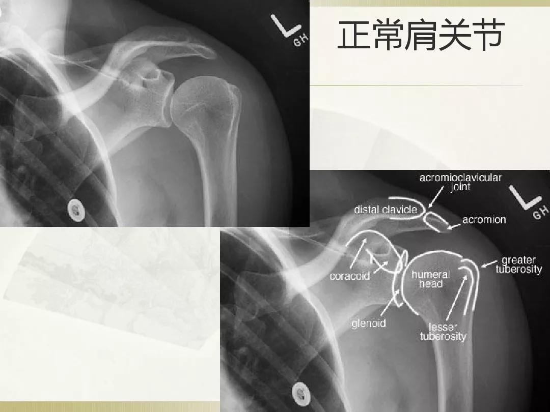 骨科x光片读片技巧,放射科骨科读片教程