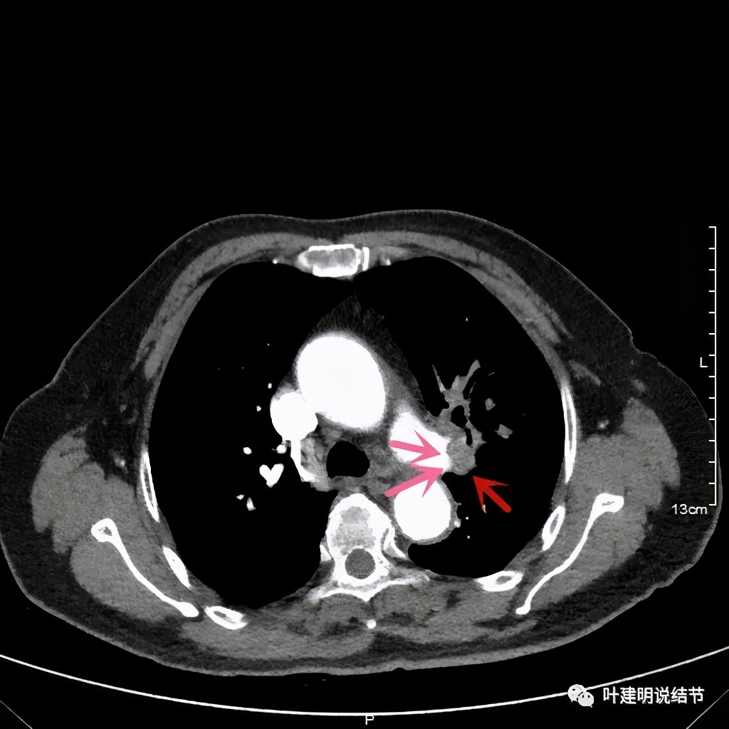 中央型肺癌手术前辅助治疗,中央型肺癌治疗后活过10年的病例