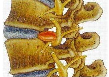 腰椎间盘突出脚肌肉萎缩怎么恢复,腰椎间盘突出会导致腿部肌肉萎缩
