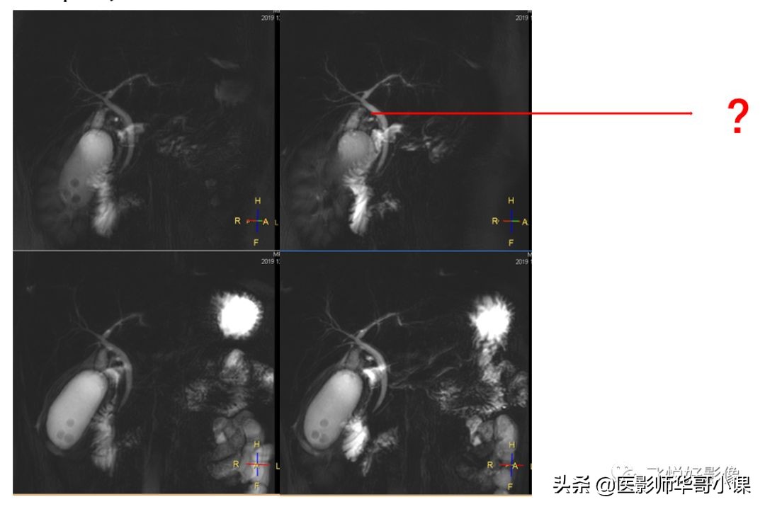 「飞利浦磁共振技术」胆道系统胆胰管水成像之3D_MRCP_BH