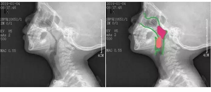 长期口呼吸的人是不是很没出息,长期口呼吸让人变丑