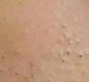 消灭黑头，男女都一样，颜值加倍