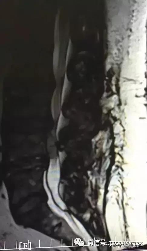 弯腰捡东西,腰痛腿麻大小便*禁失**,竞是腰椎间盘髓核脱出惹的祸