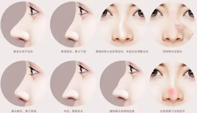 隆鼻可以做几次鼻修复,修复鼻型做哪种隆鼻好