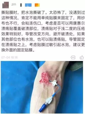 水泡破了如何处理,手掌水泡破了怎么处理