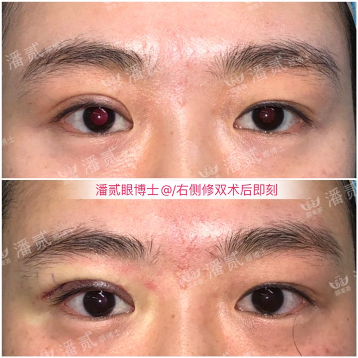韩式精雕微创双眼皮,韩式微创双眼皮恢复过程真实记录