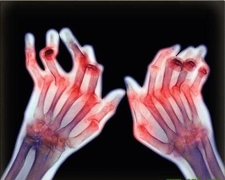 类风湿造成的关节变形可恢复吗?大多不行,有两种情况可以