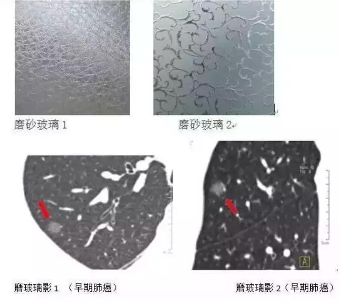 肺部小结节是什么,是早期肺癌吗?可以吃药治愈或者消失吗?