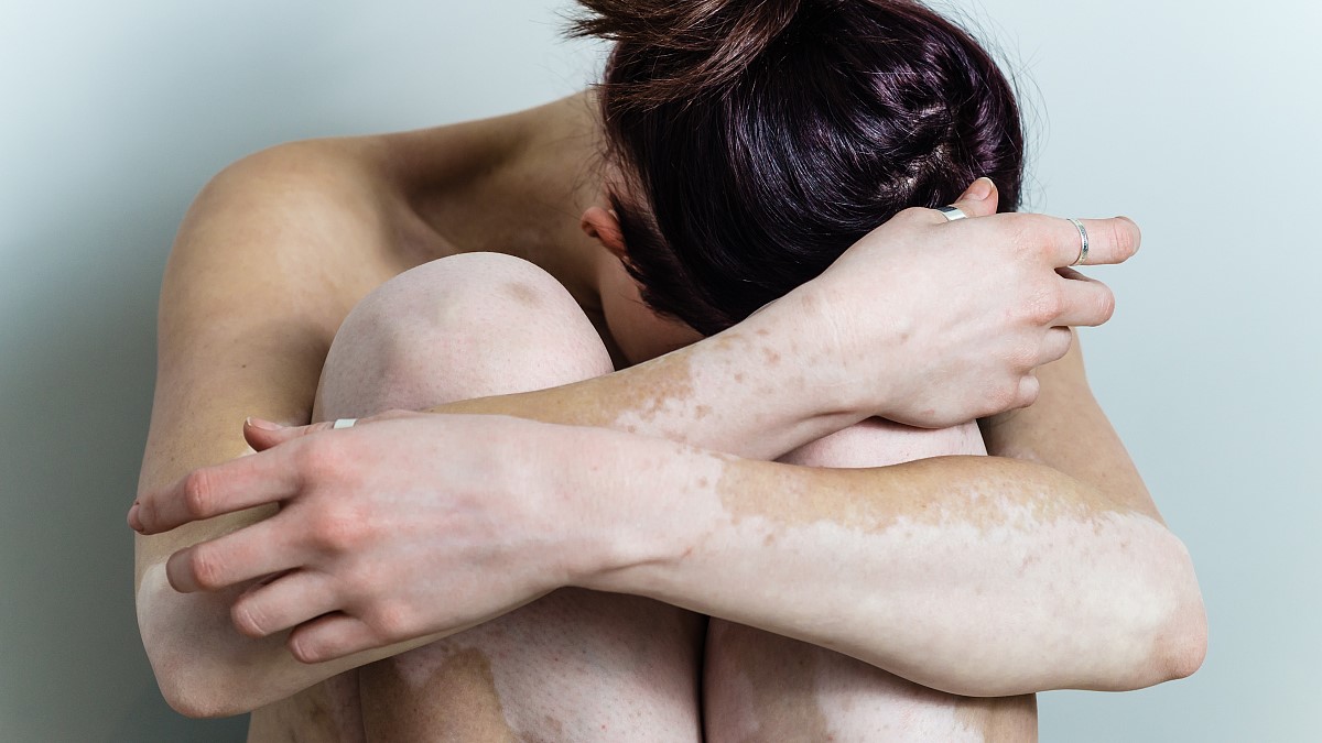 白癜风顽固难治该怎么办才好,稳定了十几年的白癜风需要治疗吗