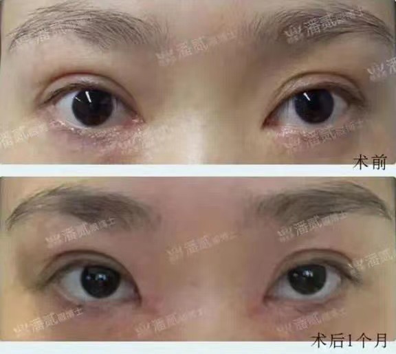 开内眼角会留疤的照片,开内眼角的疤痕变白色了怎么办