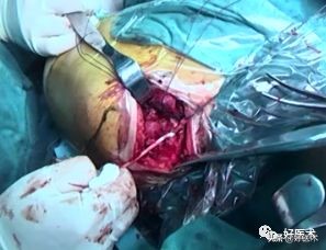 治疗肩锁关节脱位，有最好的方法吗？