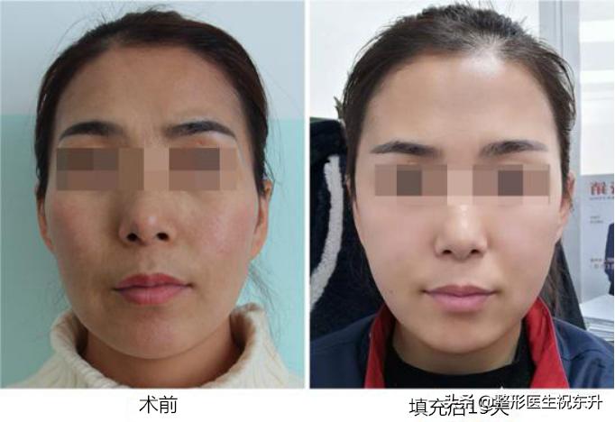 颧骨高太阳穴凹陷额头窄怎么修容,太阳穴凹陷与额头有明显棱角面相