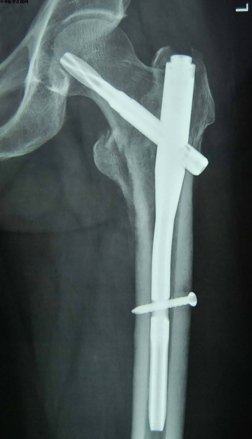 老年人髋部骨折,髋部骨折对老年人来说意味着什么