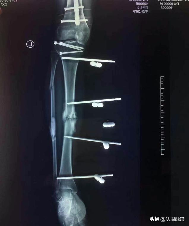 交通事故小腿胫骨骨折做手术,常德市第一中医医院骨伤科
